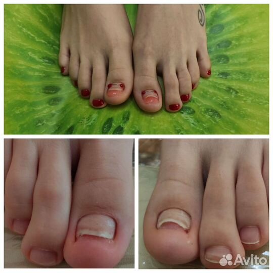 Педикюр мужской женский, подология, титановая нить