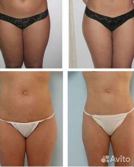 Липолитики