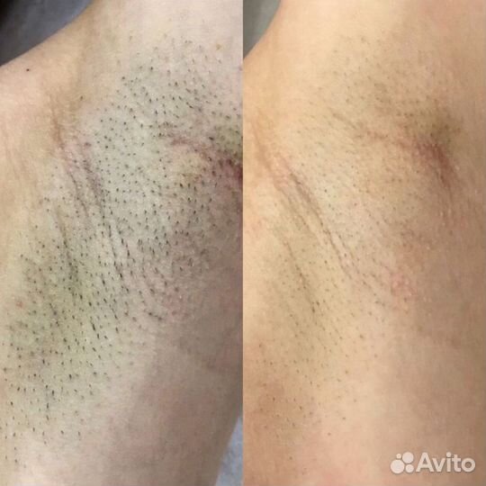 Лазерная эпиляция: глубокое бикини