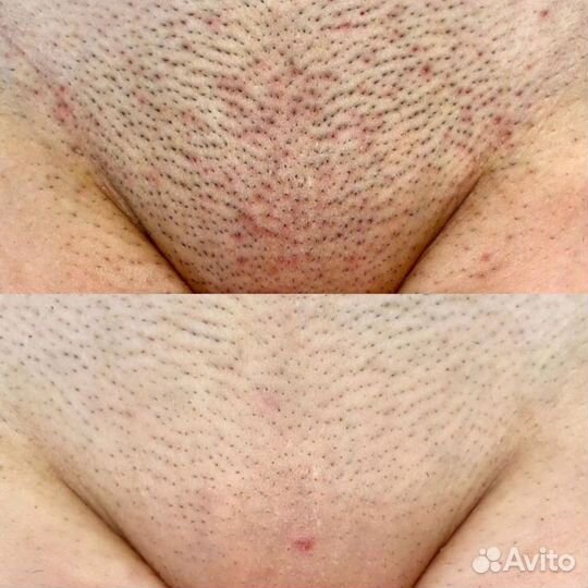 Лазерная эпиляция: глубокое бикини