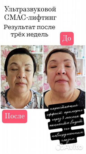 Ультразвуковой смас-лифтинг