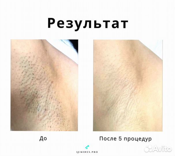 Диодный лазер Люминес’ максван 1200 Вт