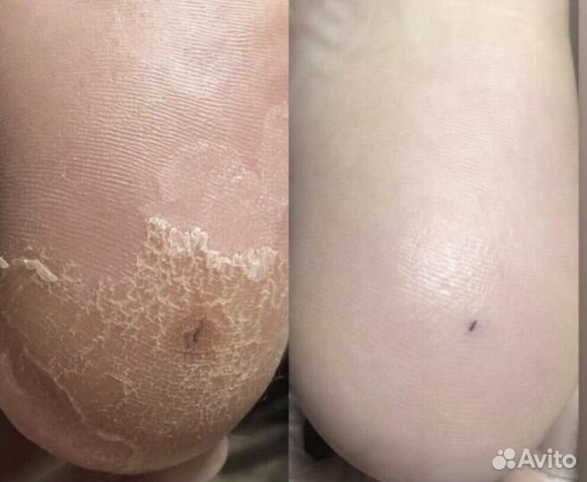 Медицинский педикюр,маникюр,все виды уходов для ру