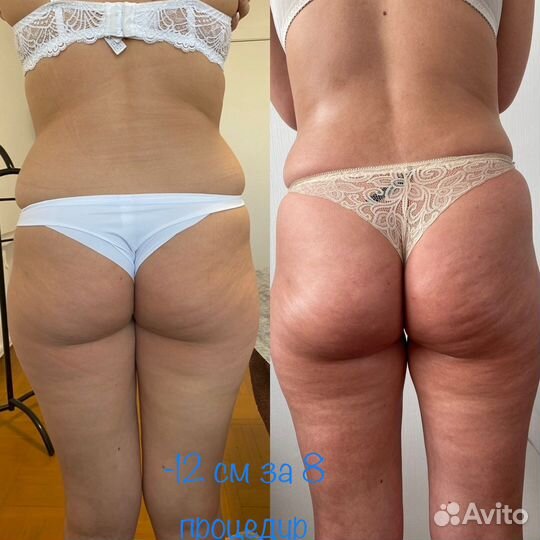 Аппаратный массаж/пресс/кавитация/RF/вибро