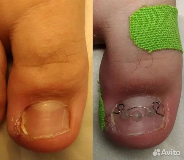 Медицинский педикюр вросший ноготь