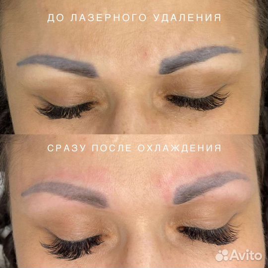 Лазерное удаление татуажа и тату