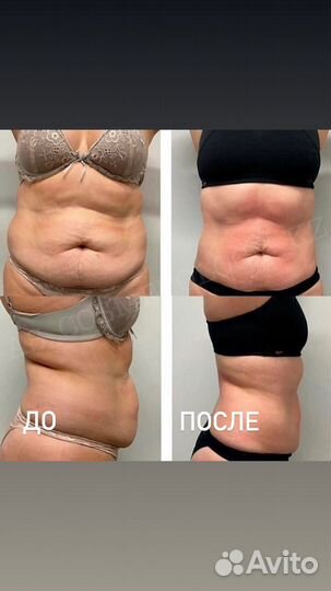 Вакуумный антицеллюлитный массаж