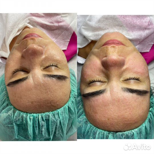 Косметолог брови чистка пилинг дермопен