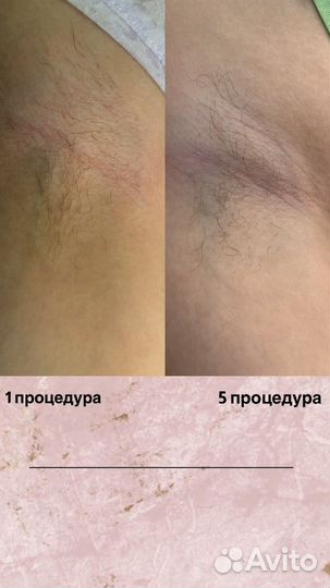 Электроэпиляция