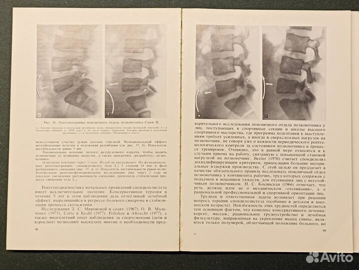Рентгенодиагностика смещений поясничных позвонков