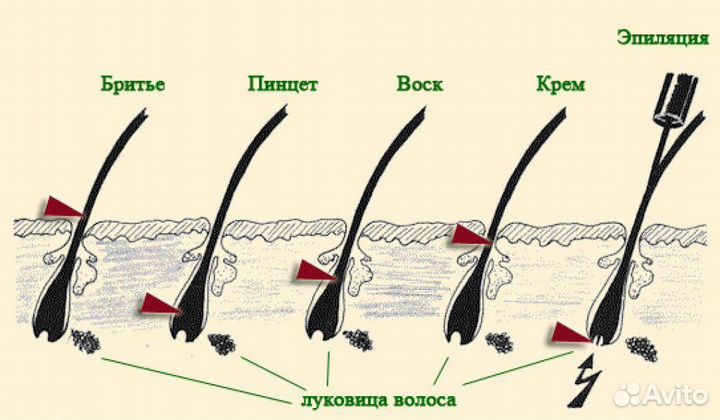 Электроэпиляция