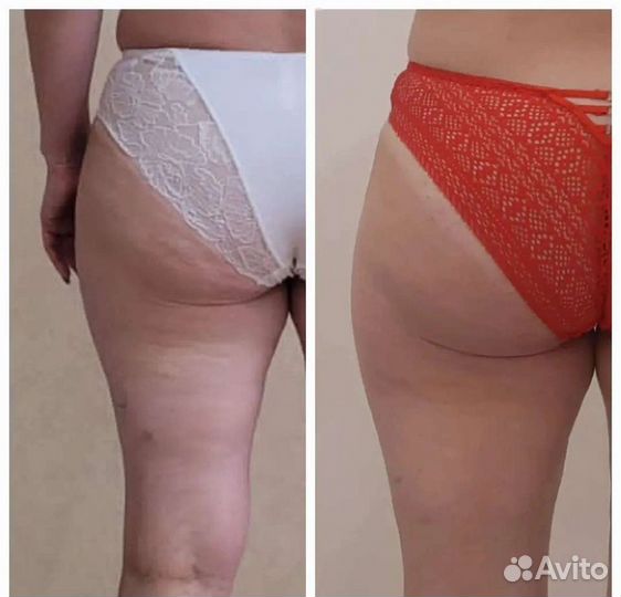 LPG - аппаратный массаж Антицеллюлитный массаж