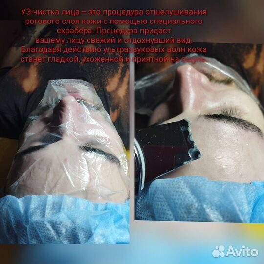 Косметолог, Чистка лица