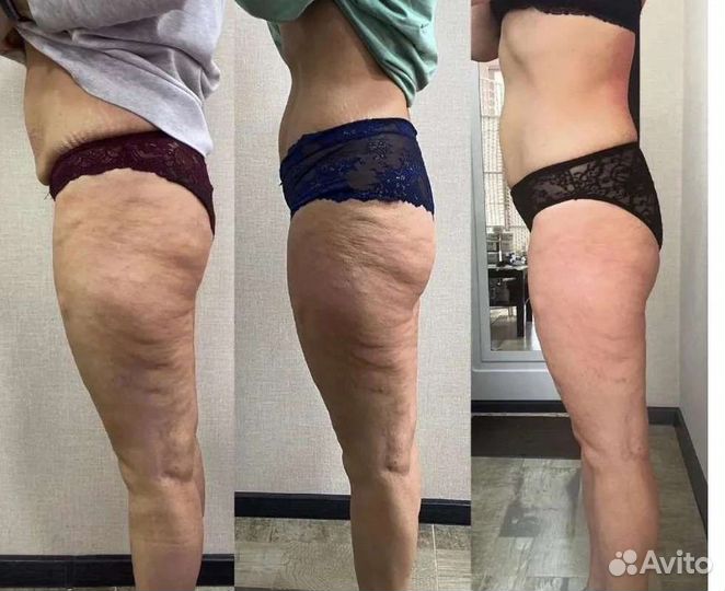 LPG - аппаратный массаж Антицеллюлитный массаж