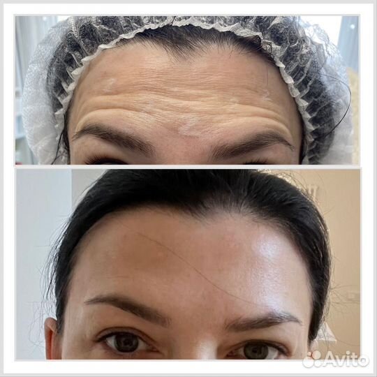 Ботокс.Устранение морщин