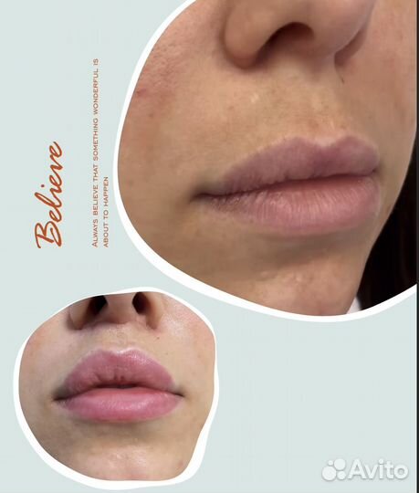 Булхорн броулифтинг