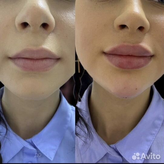 Коррекция подбородка,скулы,профиль Джоли