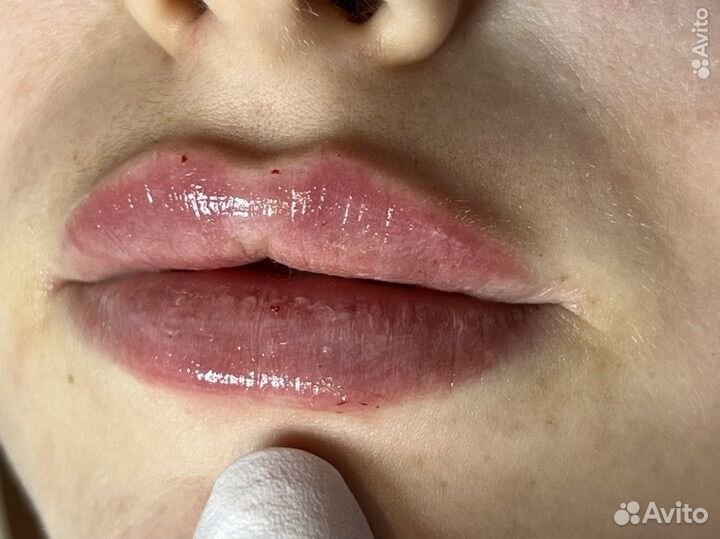 Контурная пластика губ