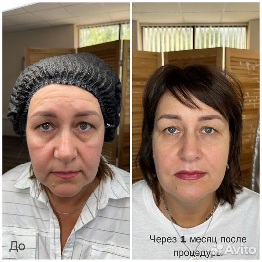 Smas lifting Омоложение кожи
