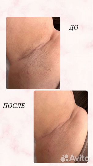 Депиляция Шугаринг Фитосмола Ильиногорск