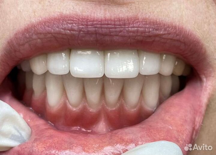 Изготовление съёмного протеза