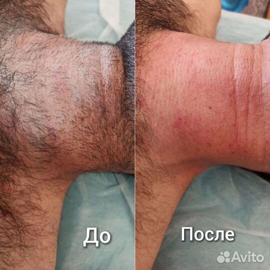 Депиляция