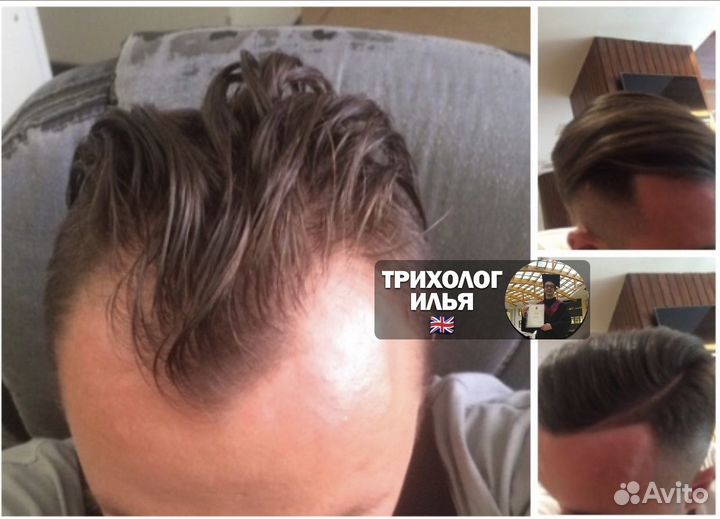 Трихолог (Остановлю Облысение) дистанционный
