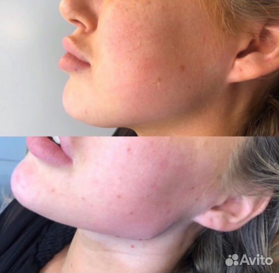 Лицо под ключ, Фулл Фейс, Овал Джоли