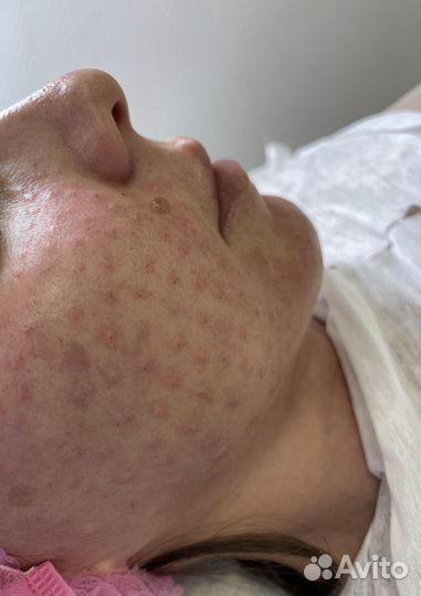 Контурная пластика губ