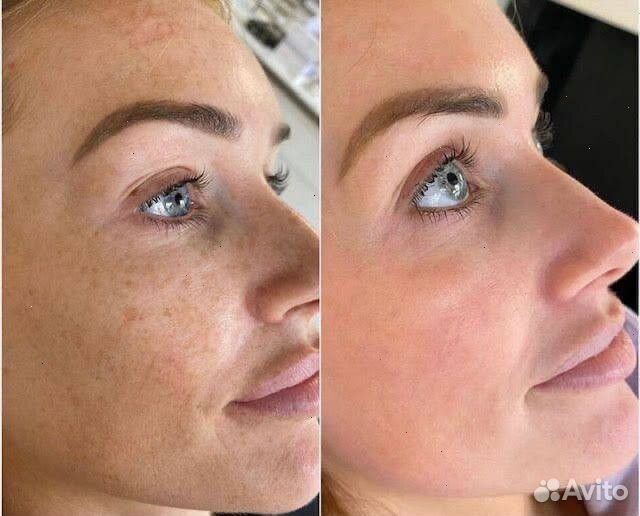 Карбоновый пилинг лица -50%