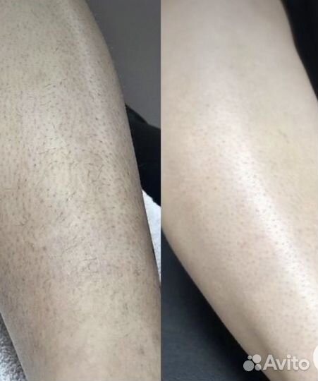 Лазерная эпиляция