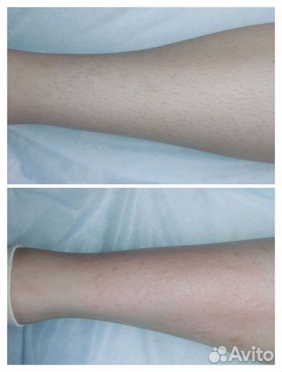 Электроэпиляция