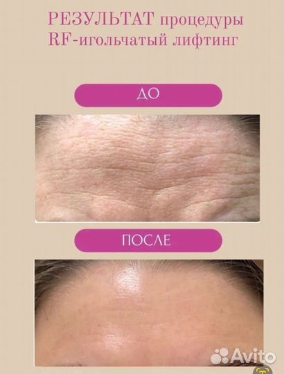 Rf игольчатый аппаратное омоложение в СПБ