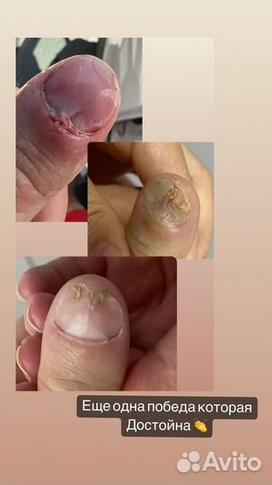 Подолог . Вросший ноготь