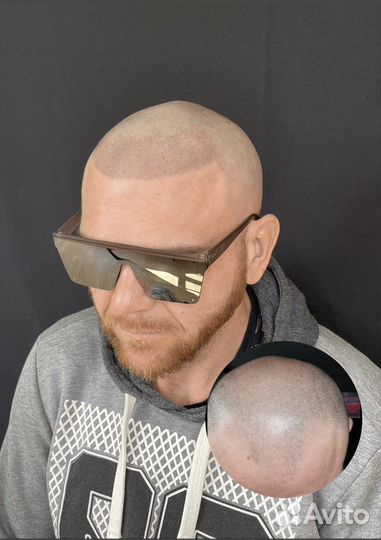 Трихопигментация SMP в Санкт-Петербурге