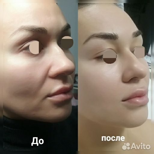 Холодная плазма, Импульсная спрей-коагуляция кожи