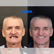 Полная имплантация челюсти На 40+ лет Рассрочка, Москва