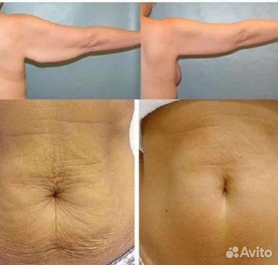 LPG - аппаратный массаж Антицеллюлитный массаж