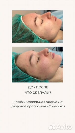 Косметолог Чистка лица Аппаратная косметология