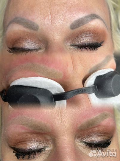 Лазерное удаление татуажа и тату