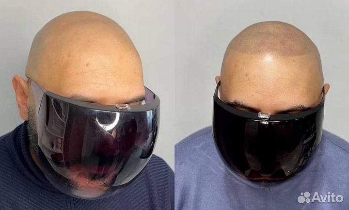 Трихопигментация головы SMP татуаж