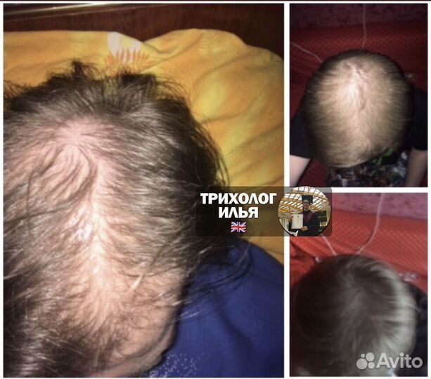 Трихолог (Остановлю Облысение) дистанционный
