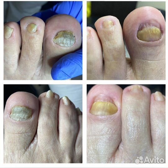 Бородавки.Мозоли.Вросшие ногти.Педикюр.Подолог