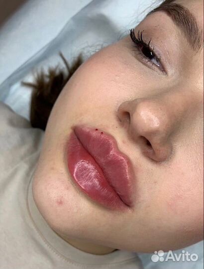 Моделирование губ увеличение