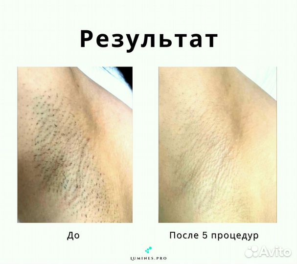 Диодный лазер Lumines Max’One 1200