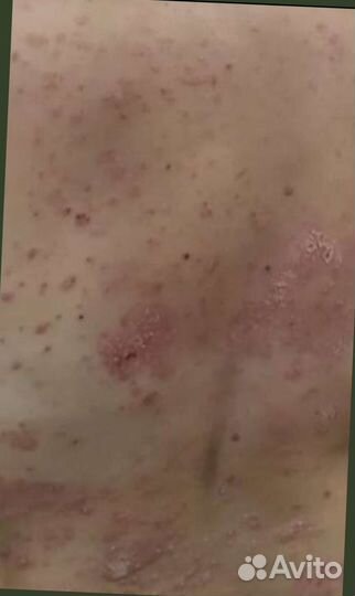 Мазь от псориаза