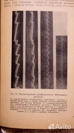 Синдром и болезнь Меньера. Кузьма Великов