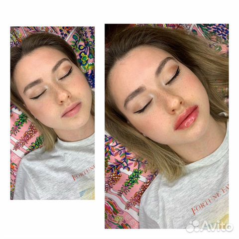 Увеличение губ/кп лица/ботокс обучение