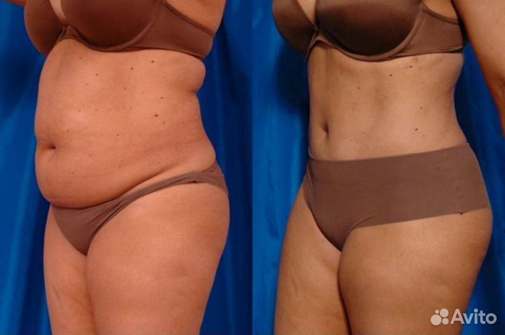 Модель на похудение, криолиполиз