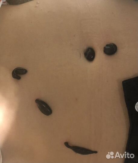 Пиявки медицинские